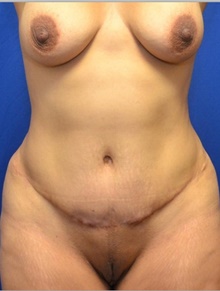 Tummy Tuck After Photo by Stanley Okoro, MD; Marietta, GA - Case 44847
