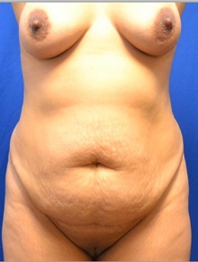 Tummy Tuck Before Photo by Stanley Okoro, MD; Marietta, GA - Case 44847