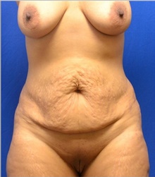 Tummy Tuck Before Photo by Stanley Okoro, MD; Marietta, GA - Case 44848