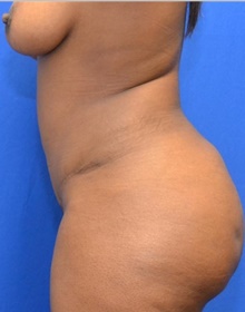 Tummy Tuck After Photo by Stanley Okoro, MD; Marietta, GA - Case 44849