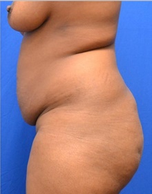 Tummy Tuck Before Photo by Stanley Okoro, MD; Marietta, GA - Case 44849