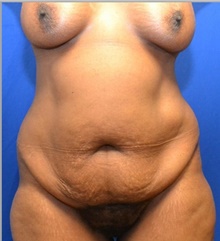 Tummy Tuck Before Photo by Stanley Okoro, MD; Marietta, GA - Case 44850