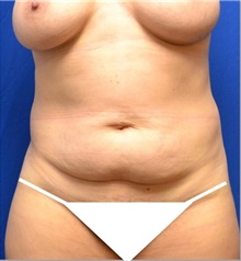 Tummy Tuck Before Photo by Stanley Okoro, MD; Marietta, GA - Case 44851