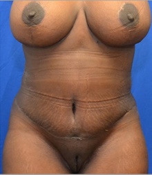 Tummy Tuck After Photo by Stanley Okoro, MD; Marietta, GA - Case 44852