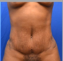 Tummy Tuck After Photo by Stanley Okoro, MD; Marietta, GA - Case 44853