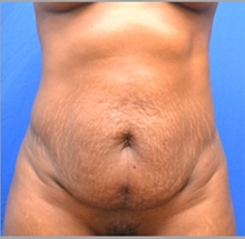 Tummy Tuck Before Photo by Stanley Okoro, MD; Marietta, GA - Case 44853