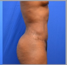 Tummy Tuck After Photo by Stanley Okoro, MD; Marietta, GA - Case 44853