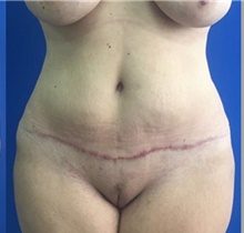 Tummy Tuck After Photo by Stanley Okoro, MD; Marietta, GA - Case 44854