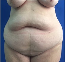 Tummy Tuck Before Photo by Stanley Okoro, MD; Marietta, GA - Case 44854