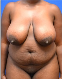 Tummy Tuck Before Photo by Stanley Okoro, MD; Marietta, GA - Case 44855