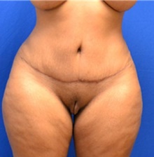 Tummy Tuck After Photo by Stanley Okoro, MD; Marietta, GA - Case 44856