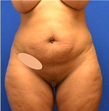 Tummy Tuck Before Photo by Stanley Okoro, MD; Marietta, GA - Case 44856