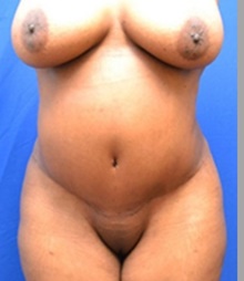 Tummy Tuck After Photo by Stanley Okoro, MD; Marietta, GA - Case 44857