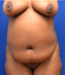 Tummy Tuck Before Photo by Stanley Okoro, MD; Marietta, GA - Case 44857