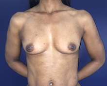 Breast Reconstruction Before Photo by Jerry Weiger Chang, MD, FACS; Flushing, NY - Case 30393