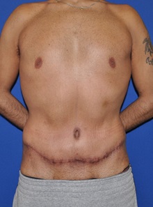 Tummy Tuck After Photo by Jerry Weiger Chang, MD, FACS; Flushing, NY - Case 30401