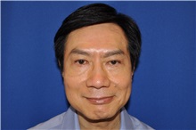 Eyelid Surgery After Photo by Jerry Weiger Chang, MD, FACS; Flushing, NY - Case 30412
