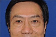 Eyelid Surgery Before Photo by Jerry Weiger Chang, MD, FACS; Flushing, NY - Case 30412