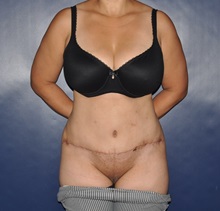 Tummy Tuck After Photo by Jerry Weiger Chang, MD, FACS; Flushing, NY - Case 30414