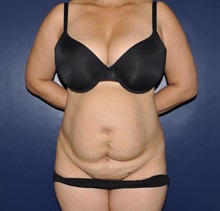 Tummy Tuck Before Photo by Jerry Weiger Chang, MD, FACS; Flushing, NY - Case 30414