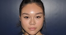 Rhinoplasty After Photo by Jerry Weiger Chang, MD, FACS; Flushing, NY - Case 35000