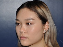 Rhinoplasty Before Photo by Jerry Weiger Chang, MD, FACS; Flushing, NY - Case 35000