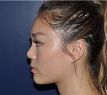 Rhinoplasty After Photo by Jerry Weiger Chang, MD, FACS; Flushing, NY - Case 35000