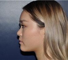 Rhinoplasty Before Photo by Jerry Weiger Chang, MD, FACS; Flushing, NY - Case 35000