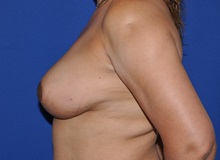 Breast Reduction After Photo by Jerry Weiger Chang, MD, FACS; Flushing, NY - Case 35001