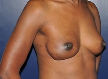 Breast Reconstruction After Photo by Jerry Weiger Chang, MD, FACS; Flushing, NY - Case 35002