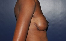 Breast Reconstruction After Photo by Jerry Weiger Chang, MD, FACS; Flushing, NY - Case 35002