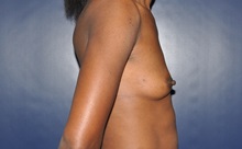 Breast Reconstruction Before Photo by Jerry Weiger Chang, MD, FACS; Flushing, NY - Case 35002