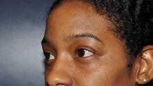 Eyelid Surgery Before Photo by Jerry Weiger Chang, MD, FACS; Flushing, NY - Case 35003