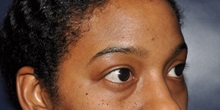 Eyelid Surgery Before Photo by Jerry Weiger Chang, MD, FACS; Flushing, NY - Case 35003