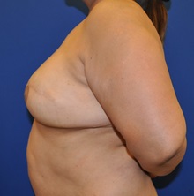 Breast Reconstruction After Photo by Jerry Weiger Chang, MD, FACS; Flushing, NY - Case 35012