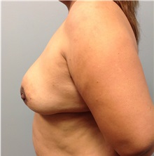 Breast Reconstruction Before Photo by Jerry Weiger Chang, MD, FACS; Flushing, NY - Case 35012