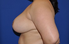 Breast Reduction After Photo by Jerry Weiger Chang, MD, FACS; Flushing, NY - Case 35014