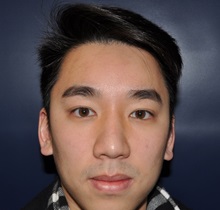 Rhinoplasty After Photo by Jerry Weiger Chang, MD, FACS; Flushing, NY - Case 35015