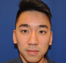 Rhinoplasty Before Photo by Jerry Weiger Chang, MD, FACS; Flushing, NY - Case 35015