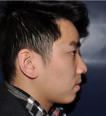 Rhinoplasty After Photo by Jerry Weiger Chang, MD, FACS; Flushing, NY - Case 35015