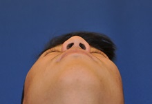 Rhinoplasty Before Photo by Jerry Weiger Chang, MD, FACS; Flushing, NY - Case 35015