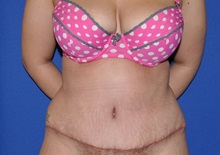 Tummy Tuck After Photo by Jerry Weiger Chang, MD, FACS; Flushing, NY - Case 35023