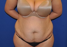 Tummy Tuck Before Photo by Jerry Weiger Chang, MD, FACS; Flushing, NY - Case 35023