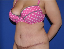 Tummy Tuck After Photo by Jerry Weiger Chang, MD, FACS; Flushing, NY - Case 35023