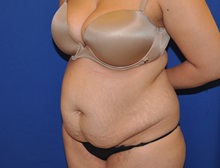 Tummy Tuck Before Photo by Jerry Weiger Chang, MD, FACS; Flushing, NY - Case 35023