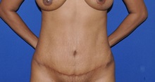 Tummy Tuck After Photo by Jerry Weiger Chang, MD, FACS; Flushing, NY - Case 35025