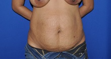 Tummy Tuck Before Photo by Jerry Weiger Chang, MD, FACS; Flushing, NY - Case 35025