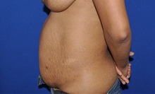 Tummy Tuck Before Photo by Jerry Weiger Chang, MD, FACS; Flushing, NY - Case 35025