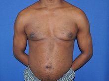 Male Breast Reduction After Photo by Jerry Weiger Chang, MD, FACS; Flushing, NY - Case 35028