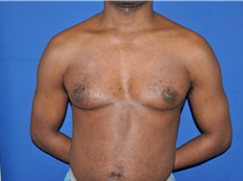 Male Breast Reduction Before Photo by Jerry Weiger Chang, MD, FACS; Flushing, NY - Case 35028